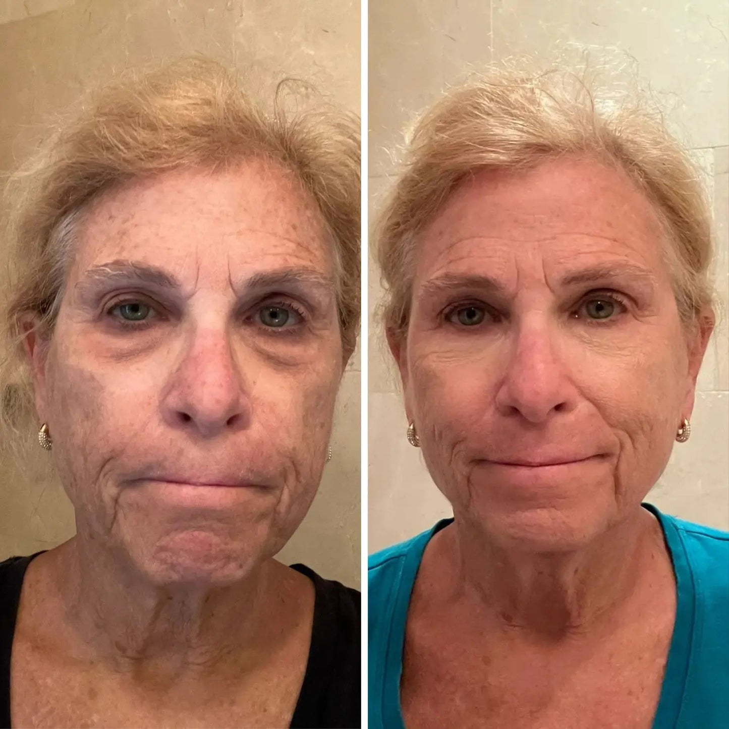 Undea solución para ojeras