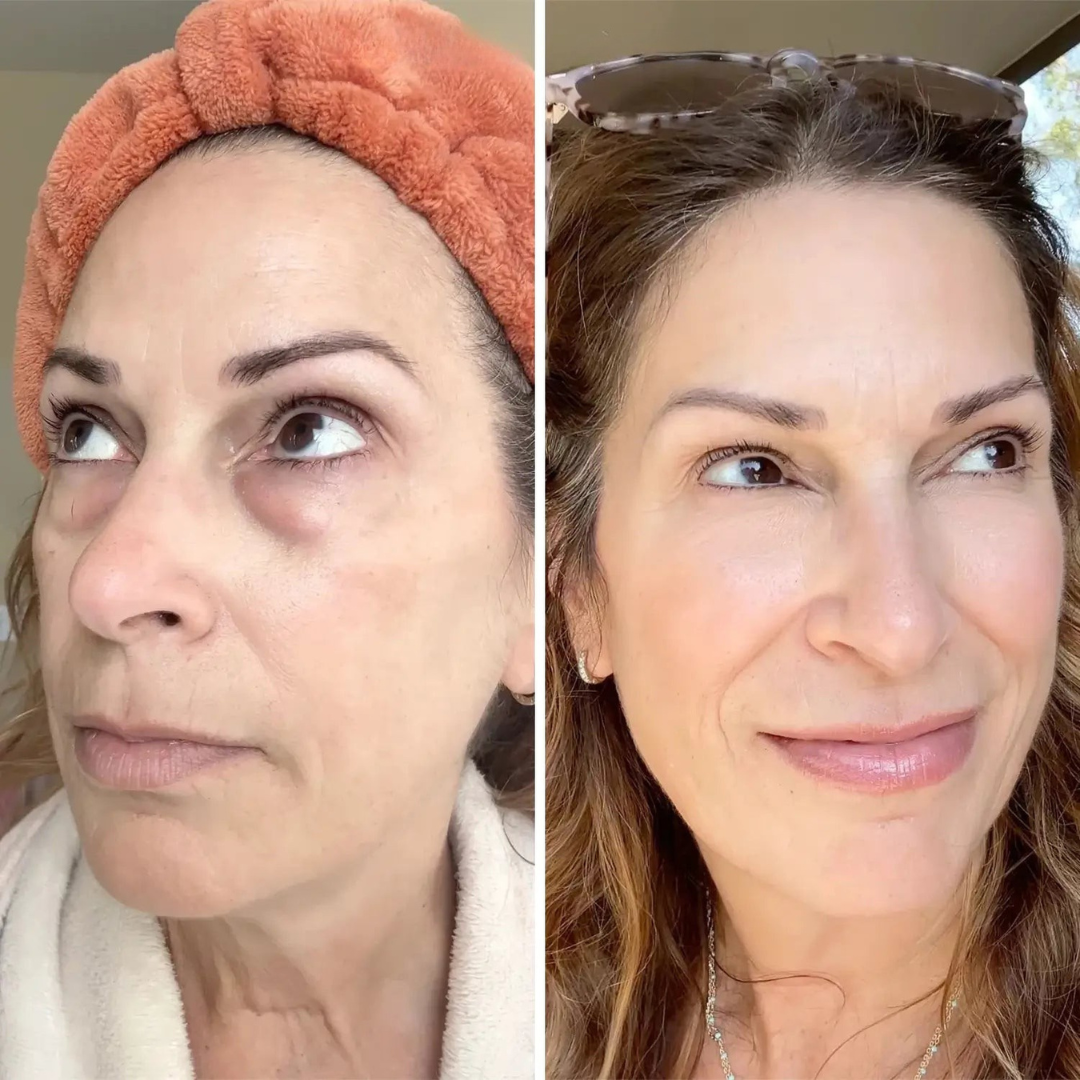 Undea solución para ojeras