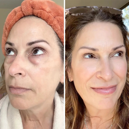 Undea solución para ojeras